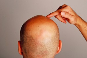 Männer sind häufiger von Haarausfall betroffen als Frauen